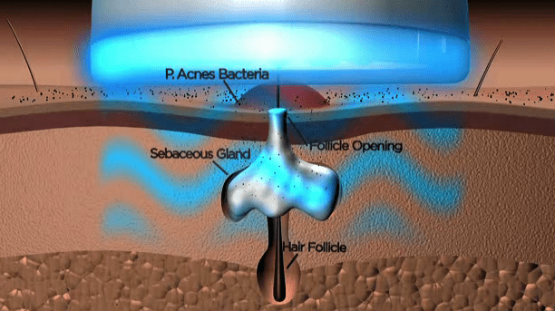 Blue-LED-light-acne-bacteria