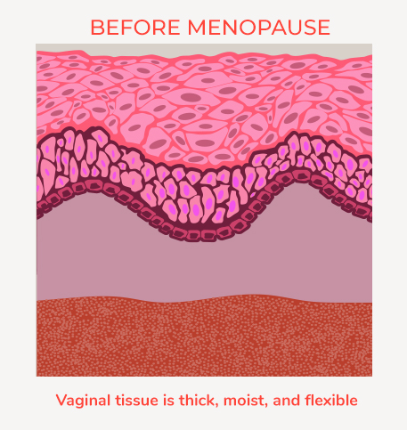 Vulvar Vaginal Atrophy or VVA affects women in menopause. This is the look of Vaginal tissue before menopause.