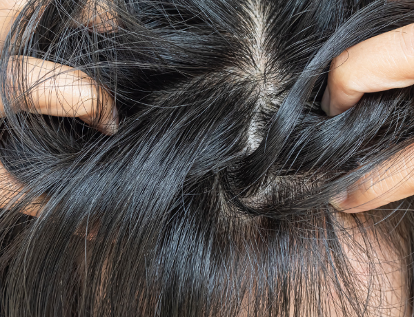 Know Affordable and Easy Dandruff Hair Care Tips