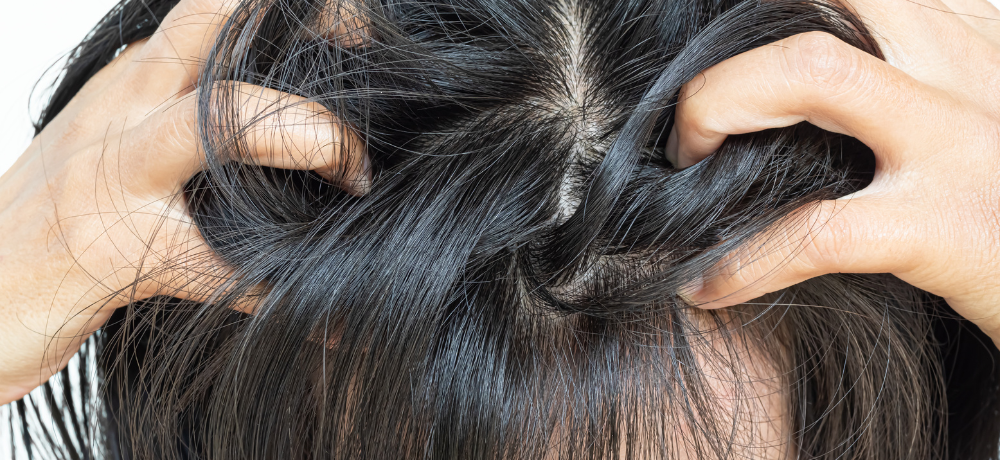 dandruff scalp in a woman